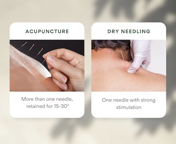 Acupuncture and Dry Needling Image